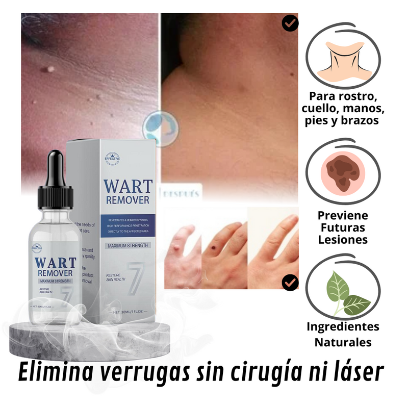 Removedor de verrugas Wart Remover